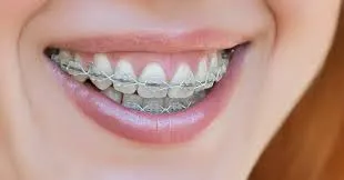 The Complete Guide to Orthodontics What You Need to Know for a Healthy Smile