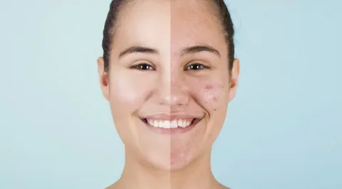 What is Niacinamide & What Can It Do For My Acne Issues?