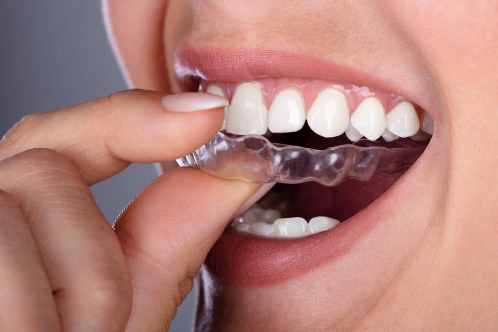 How Clear Aligners Can Transform Your Smile Discreetly