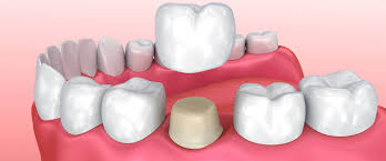 Turkey Teeth Packages: Dental implants, Veneers and Crowns